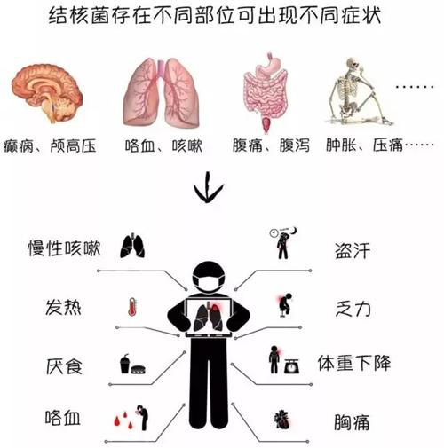 肺结核照片图解图片